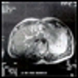 Eovist Injection and Resovist Injection: Two New Liver-Specific Contrast Agents for MRI