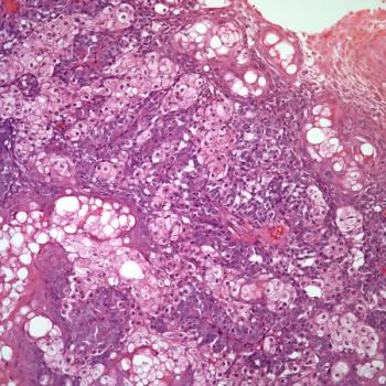 Phase 1 data may support the potential activity and safety of VCN-01 among pediatric patients with refractory retinoblastoma.