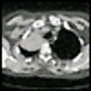 Management of a Superior Sulcus (Pancoast) Tumor