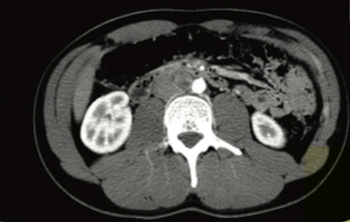Management of Testicular Germ Cell Tumor With Somatic-Type Malignancy