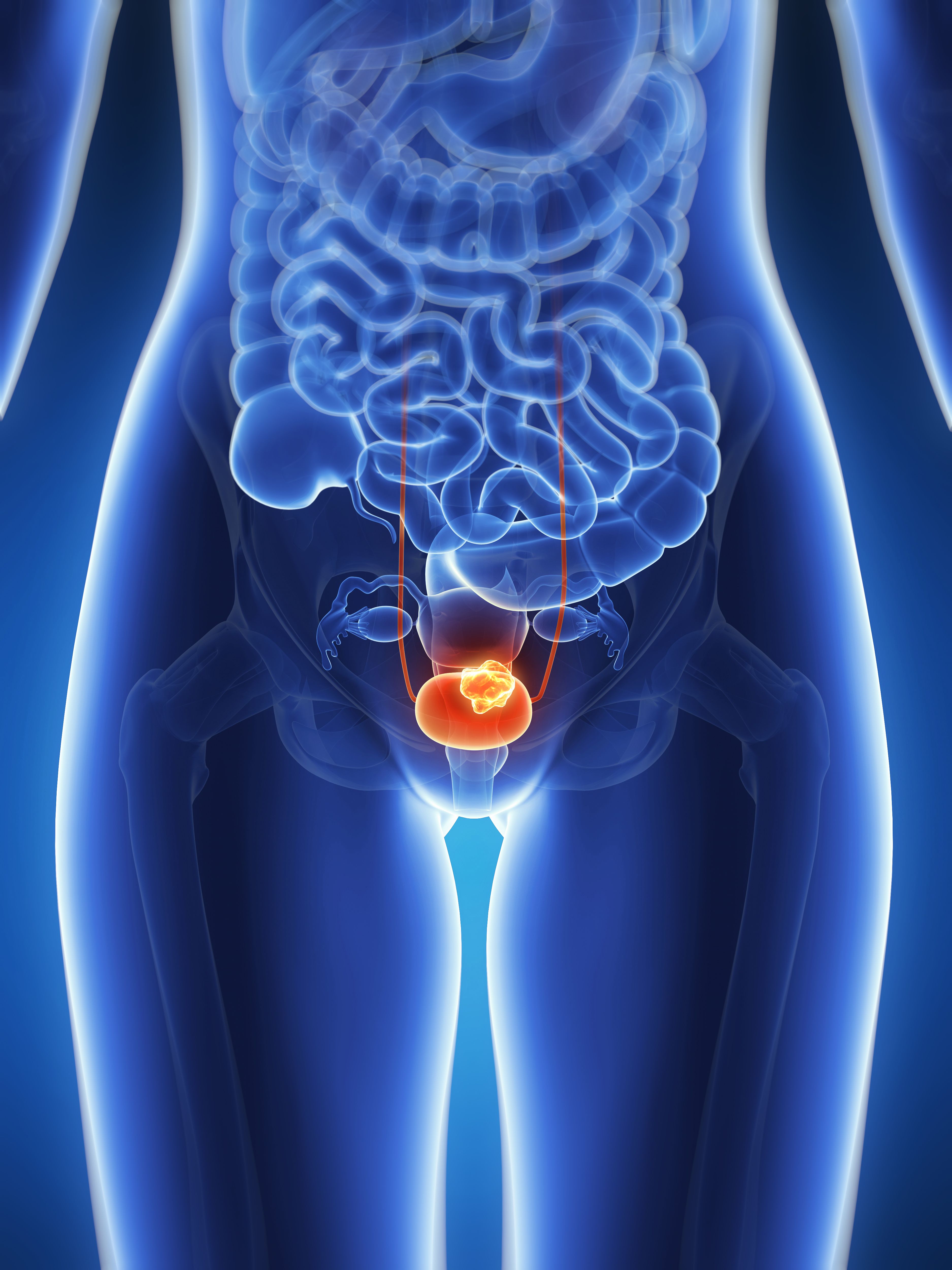 person with bladder cancer