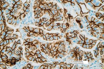 trastuzumab, HER2, breast cancer