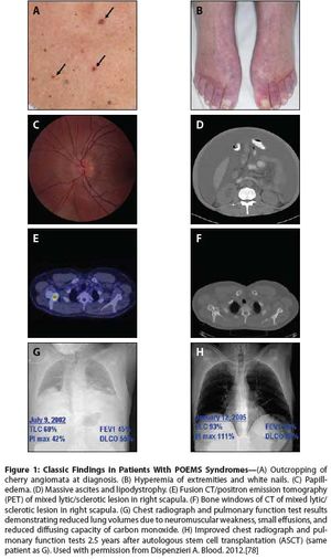 A Review of POEMS Syndrome