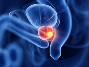 3d rendered medically accurate illustration of prostate cancer | Image Credit: © Sebastian Kaulitzki - stock.adobe.com