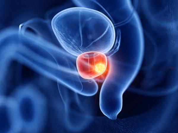 3d rendered medically accurate illustration of prostate cancer | Image Credit: © Sebastian Kaulitzki - stock.adobe.com