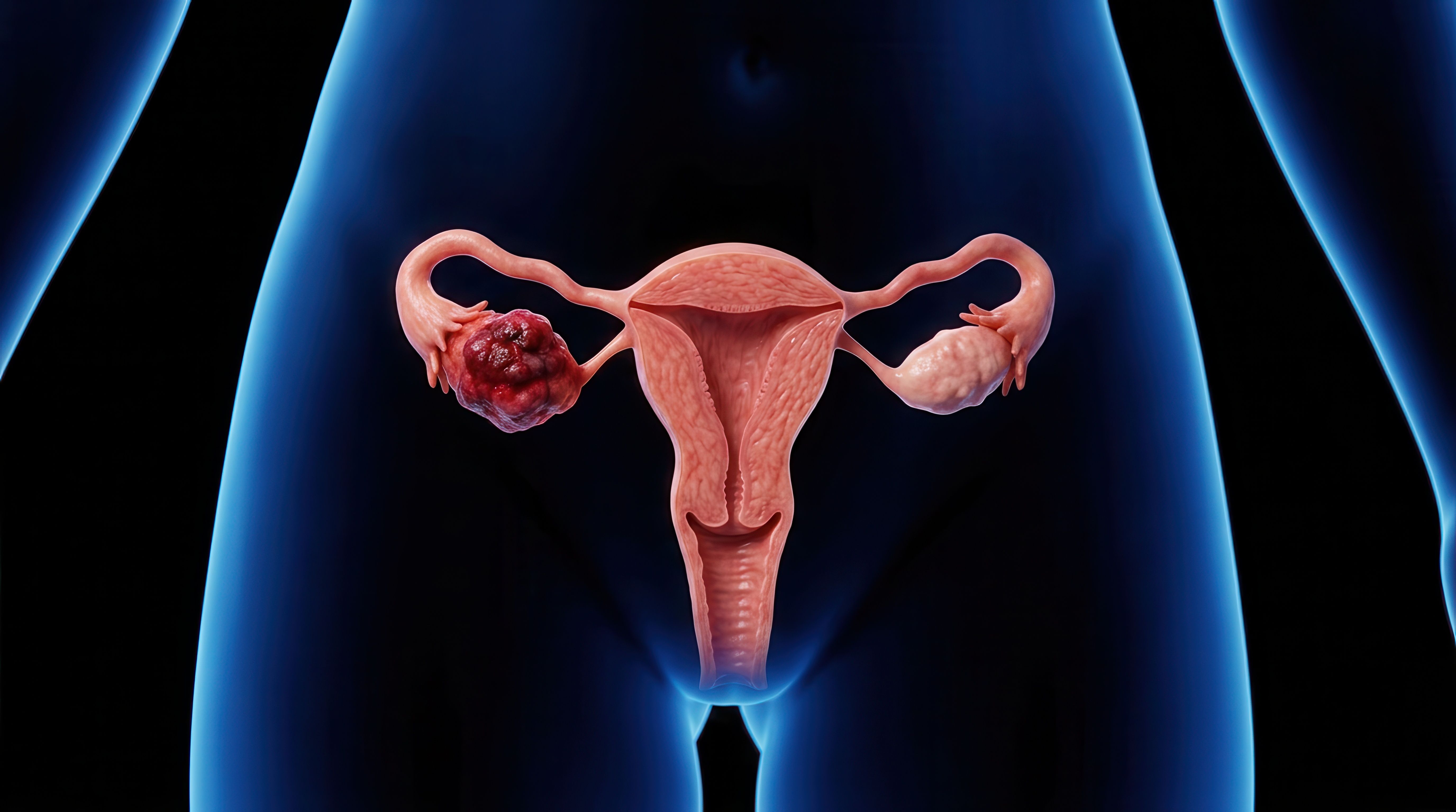Women with Ovarian Cancer in High SVI Areas Experience Worse OS Outcomes: © Masque - stock.adobe.com