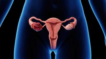 Women with Ovarian Cancer in High SVI Areas Experience Worse OS Outcomes: © Masque - stock.adobe.com