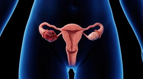 Women with Ovarian Cancer in High SVI Areas Experience Worse OS Outcomes: © Masque - stock.adobe.com