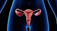Women with Ovarian Cancer in High SVI Areas Experience Worse OS Outcomes: © Masque - stock.adobe.com