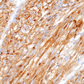 Olverembatinib has shown promising clinical efficacy in SDH-deficient gastrointestinal stromal tumors, says Haibo Qiu, MD.
