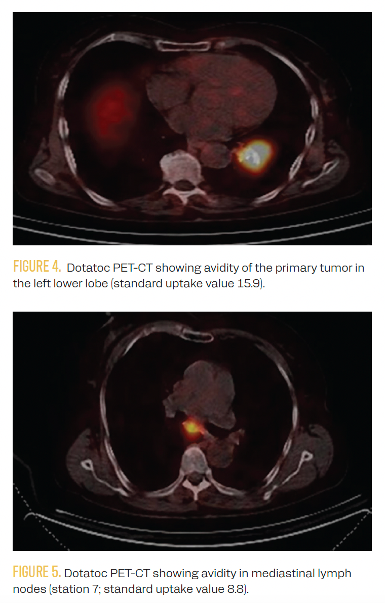 Neoadjuvant Capecitabine Plus Temozolomide in Atypical Lung NETs