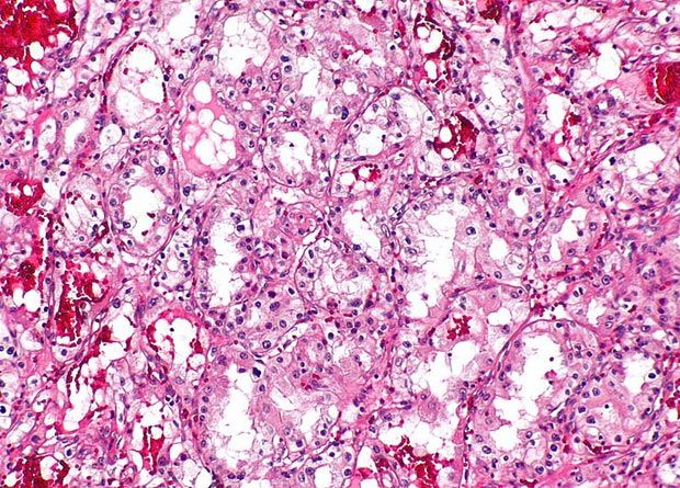 presentation of renal cell carcinoma