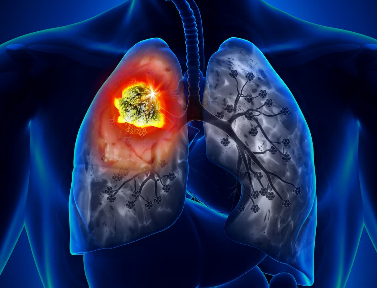 Pembrolizumab/Chemo Numerically Improves PFS Vs Chemo in