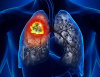 Data from the phase 2 TUXEDO-3 trial support patritumab deruxtecan as a novel treatment option across different cancer populations with brain metastases.