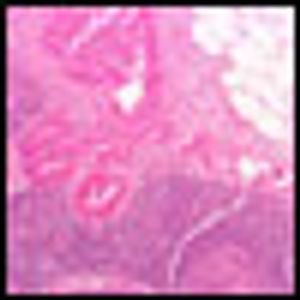 Is it Time to Cut Lymph Node Status from Breast Cancer Prognosis?
