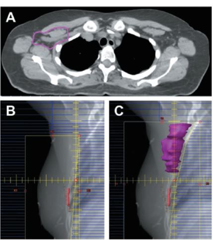 The Use of Surgery and Radiotherapy as Treatment of Regional Nodes in ...
