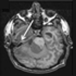 Tailored Therapy in Diffuse Gliomas: Using Molecular Classifiers to Optimize Clinical Management