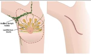 Current Strategies for the Management of Locoregional Breast Cancer Recurrence