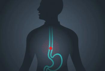 Data from the phase 3 SKYSCRAPER-08 trial may support tiragolumab plus atezolizumab and chemotherapy as an alternative frontline treatment option for those with locally advanced or metastatic esophageal squamous cell carcinoma.