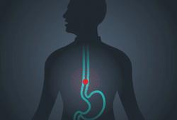 Early Vs Delayed Surgery Associated With Improved Survival in Stage II/III Esophageal Cancer 