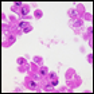 Pleural Fluid Analysis Shows Malignant Cells