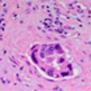 A Large Cystic Pancreatic Mass in a 45-Year-Old Female