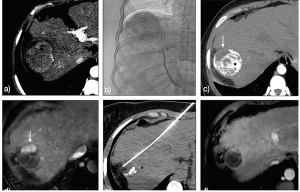 How to Radiologically Assess and Follow Response After Treatment of Hepatocellular Carcinoma 