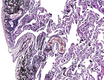 Lung cancer, lung tumor, molecular testing