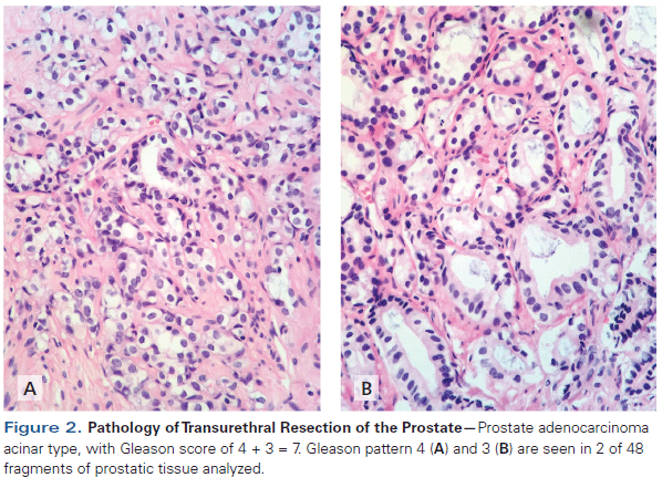 adenocarcinoma acinar prostata gleason 7(34) prostatita bacteriana cauze