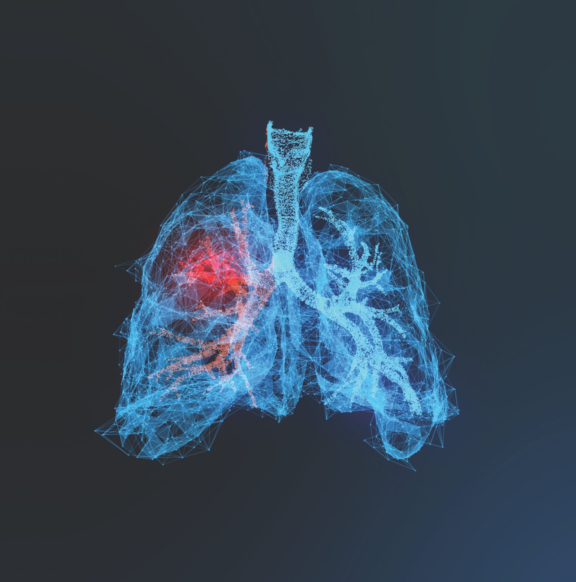 An illustration of a human lung with cancer