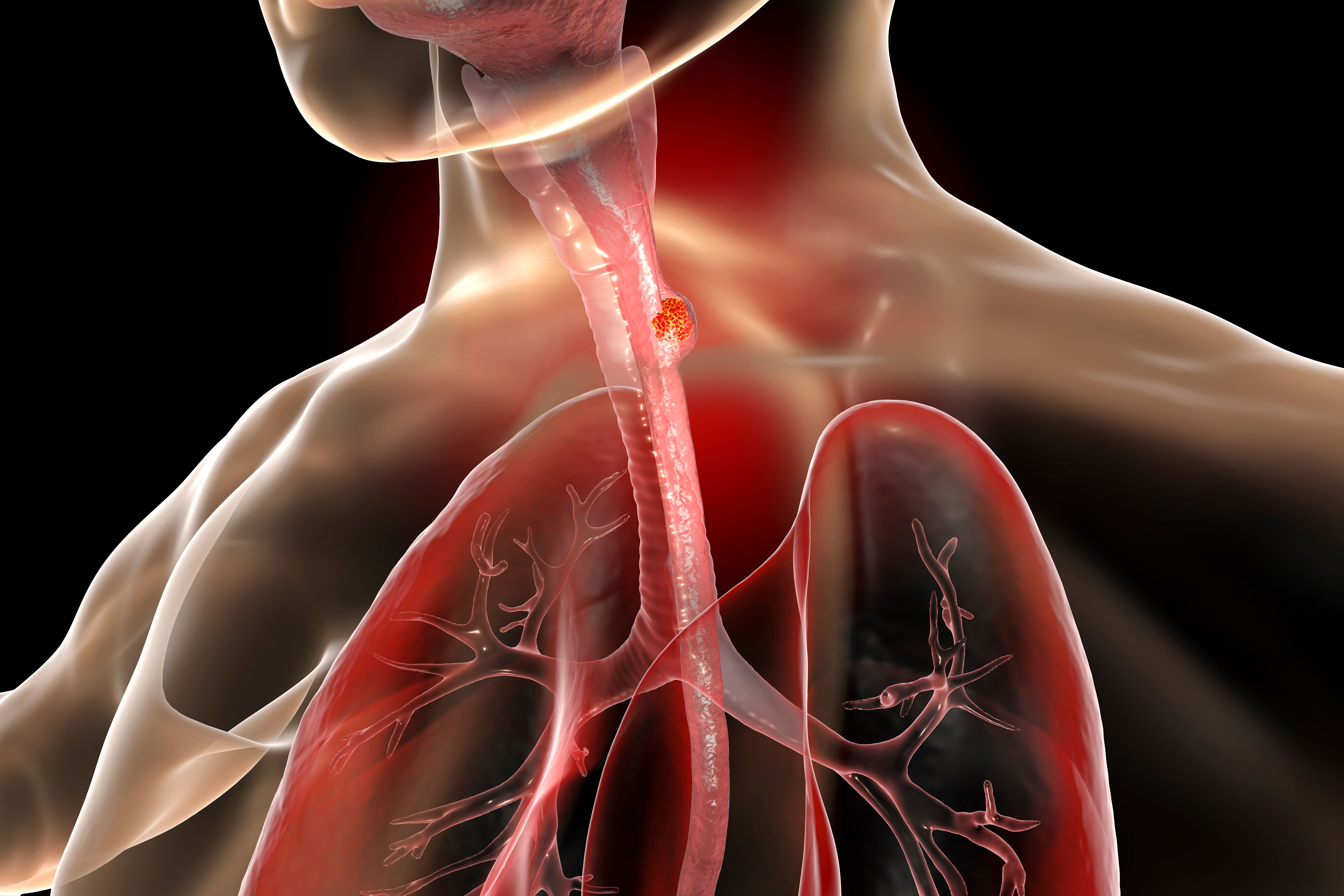 Subgroup data from RATIONALE-306 support the frontline use of tislelizumab plus chemotherapy in locally advanced esophageal squamous cell carcinoma.