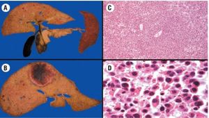 Multiple Myeloma With Extramedullary Disease: A Challenging Clinical Dilemma