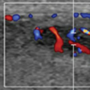 Nonpalpable Intratesticular Mass in a Young Man With a History of Contralateral Retractile Testis