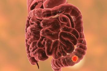 Botensilimab Plus Balstilimab Yielded Pathologic Responses in Colorectal Cancer: © Dr_Microbe - stock.adobe.com
