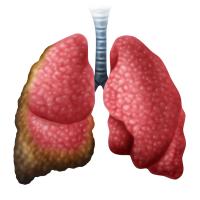 AI-Based Pan-TEAD Inhibitor Wins FDA Fast Track Designation in Mesothelioma