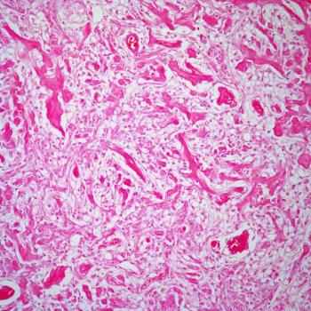Overall survival is expected to continue improving among patients with glioblastoma being treated with frontline olaptesed pegol plus radiotherapy and bevacizumab who remain on the phase 1/2 GLORA study.