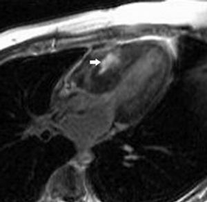 Locally Advanced Rectal Cancer, What is the Standard of Care?