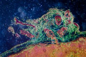 Cutaneous T-Cell Lymphoma: Current and Emerging Therapies