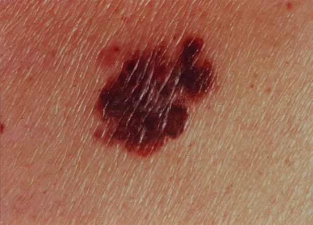 Asymmetrical melanoma lesion