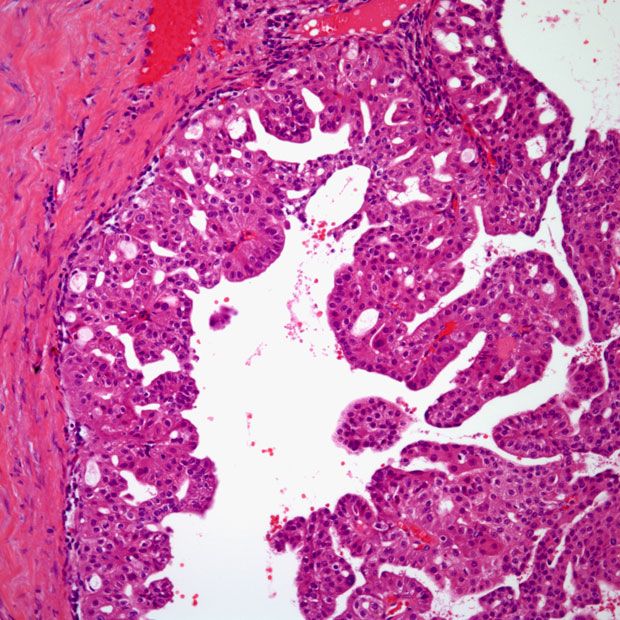 PYX-201 is currently being investigated in a phase 1 trial in patients with solid tumors.