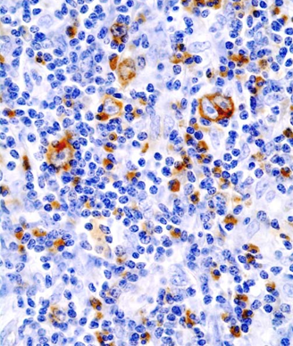 A larger, phase 2 trial is planned to further evaluate pembrolizumab plus doxorubicin, vinblastine, and dacarbazine in patients with newly diagnosed Hodgkin lymphoma.