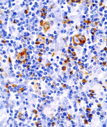 A larger, phase 2 trial is planned to further evaluate pembrolizumab plus doxorubicin, vinblastine, and dacarbazine in patients with newly diagnosed Hodgkin lymphoma.