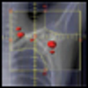 Combined-Modality Therapy for Early-Stage Hodgkin Lymphoma: Maintaining High Cure Rates While Minimizing Risks