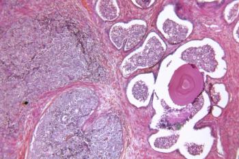 During the ODAC meeting, members voted to restrict the use of olaparib plus abiraterone and prednisone or prednisolone to patients with BRCA-mutated metastatic castration-resistant prostate cancer.