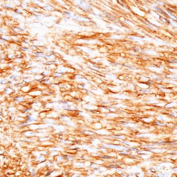 The therascreen PDGFRA RGQ PCR kit has become the first FDA-approved companion diagnostic designed to detect platelet-derived growth factor receptor alpha gene mutations.