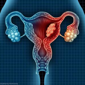 Endometrial cancer markers for earlier diagnosis 