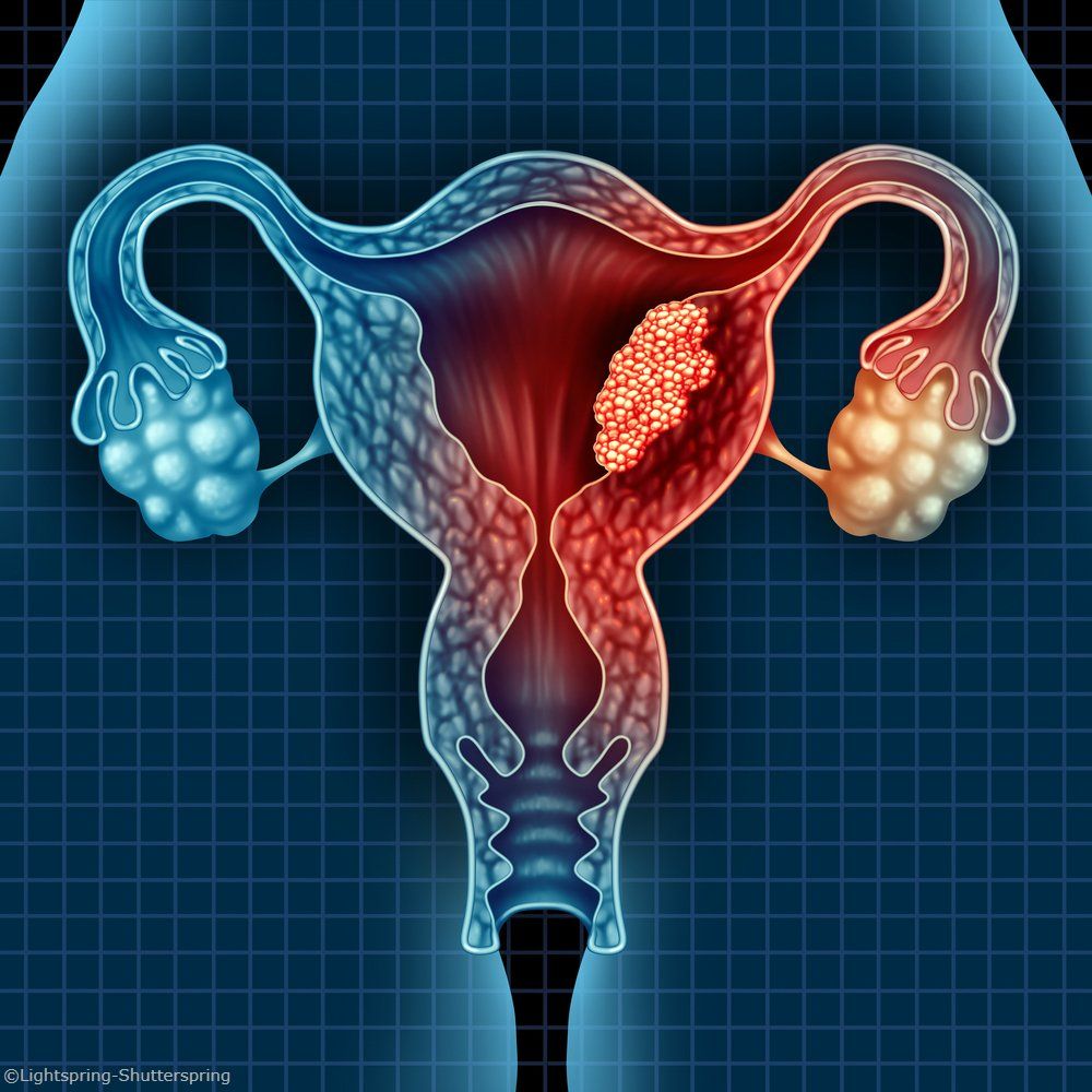 Postmenopausal Bleeding Common in Women With Endometrial Cancer