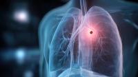 A Nonclassical ALK Fusion Lunc Adenocarcinoma With Brain Mets Case Study: © appledesign - stock.adobe.com