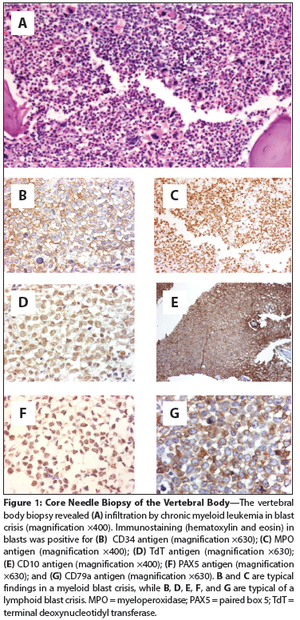 Biphenotypic Extramedullary Blast Crisis of Chronic Myeloid Leukemia With Variant Philadelphia Chromosome Translocation