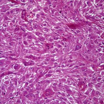 The FDA fast track designation for paxalisib and radiotherapy for PI3K-mutant solid tumor brain metastases is supported by data from a phase 1 study.
